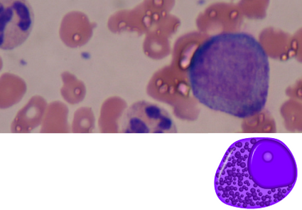 Leucemia promielocítica aguda